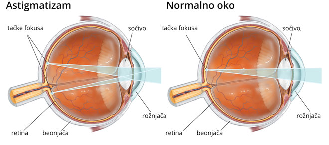 Šematski prikaz astigmatizama