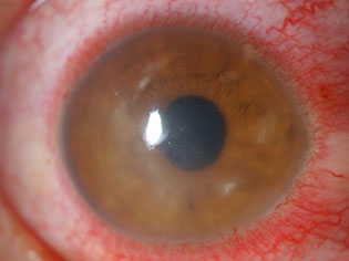 Bakterijski keratitis