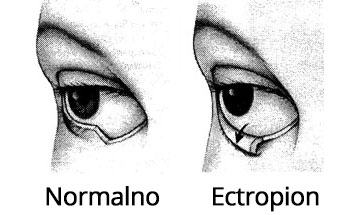 Normalno oko i Ectropion