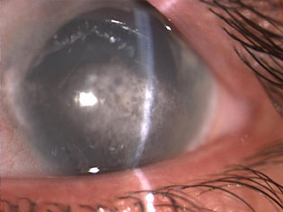 Gljivični keratitis