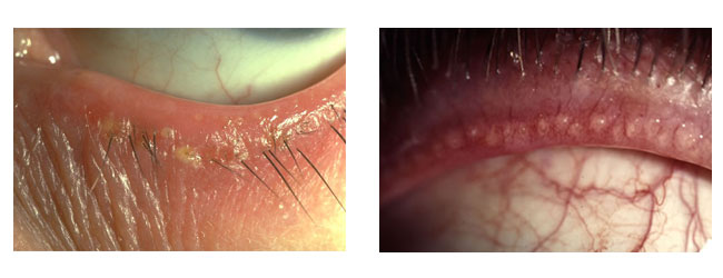 Prednji i zadnji blefaritis