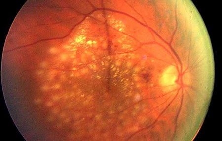 Lokalizovana laser fotokoagulacija