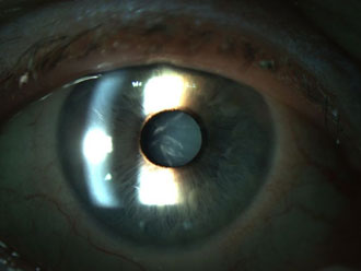 Sekundarna katarakta